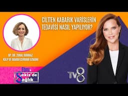 CİLTTEN KABARIK VARİSLERİN TEDAVİSİ NASIL YAPILIYOR?| OP. DR. ZUHAL DURMAZ | 8'de Sağlık