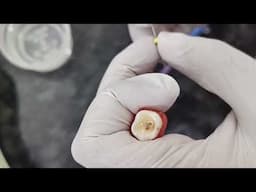 HOW TO DO MOLAR RCT
