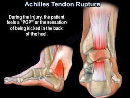Achilles Tendon Rupture Symptoms, Diagnosis, and Treatment