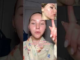 how to clear hyperpigmentation… FAST‼️🚨