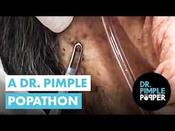 60 Minutes of Dr Pimple Popper's Favorites! A Dr Pimple Popathon