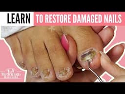 Runner’s Toenail Recovery: Cracked, Raised, and White Spots Toenail Restoration
