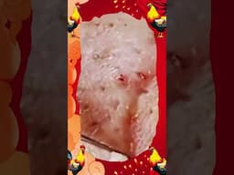 Blackheads Removal | Acne Treatment and Very Satisfying Satisfying Pimple pop #blackheads