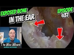 EXPOSED BONE IN THE EAR! Episode 437 (and a surprise in the other!)