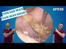 Sticky Ear Wax, Dry Skin & Surprising Eardrum Movement! 👂🔥   EP1139