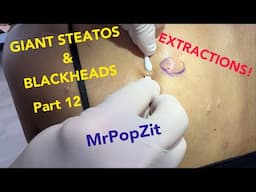 This one has it all! BLACKHEADS, STEATOS, ingrown hairs, vellus hair cysts, so many extractions!