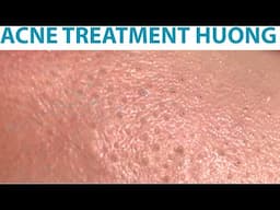 Acne Treatment Huong Da Nang#734 Have a nice weekend!