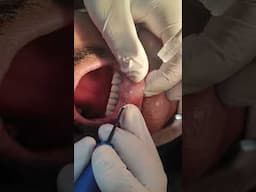 Removing a lesion over the lip #shorts