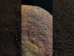 Hair transplant to fix density #vincihairclinic #shorts