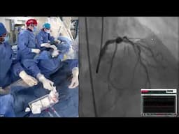 Live Case #3 - LAD/D1 Bifurcation PCI using Mini-Crush and RA
