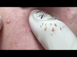 Short Acne Video - Acnes Treatments Mai Ngoc 💕💕💕