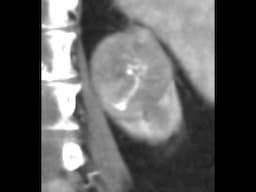 Renal Oncocytoma