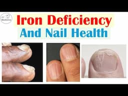Iron Deficiency and Nail Health | 2 Nail Conditions Caused By Iron Deficiency