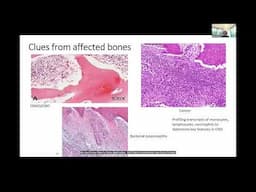 2025 CRMO Family Conference | Research Update CNO