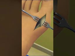 Bunion Surgery Explained: What is bunionectomy #medical3danimation