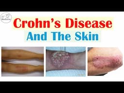 Crohn's Disease and the Skin | 4 Skin Findings of Crohn's Disease