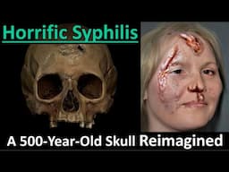 See How Syphilis Destroyed a Woman & Her Skull 500 Years Ago- Recreated to Real Life