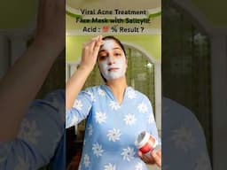 Viral Acne Treatment : Face Mask with Salicylic Acid 💯 % Result ?