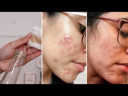Como eu estou me livrando das espinhas com vinagre de maçã 🍎   antes e depois & como eu uso