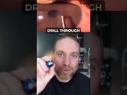 Eye Foreign Body Removed With Algar Brush!
