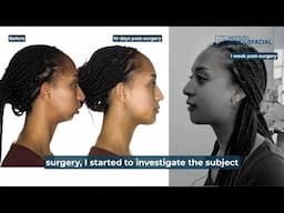 Monomaxillary Surgery Case #165: Ma. Fernanda - Mandibular hypoplasia, Class II, Open bite