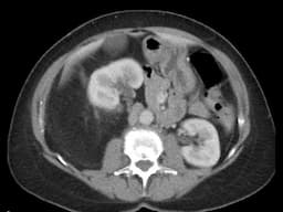 Liposarcoma