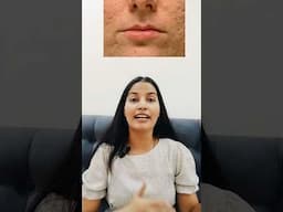 Day 4 Remove Acne Scars #acnescars
