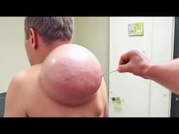 it started as a mosquito bite..