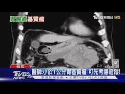 肚子痛.腹脹可能不是小病! 小心「胃腸道基質瘤」作怪 不可輕忽!｜十點不一樣20250605 @TVBSNEWS01