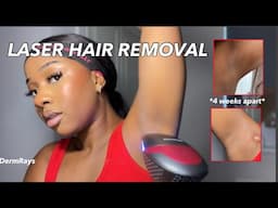 AT HOME LASER HAIR REMOVAL | 4 weeks review using DermRays V6S