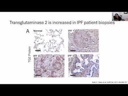 Transglutaminase 2 Knockout Mice are Protected from Bleomycin-Induced Lung Fibrosis