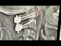 C1-C2 spine instability- fixation treatment #backpain #neckpain #spine #roboticspinesurgery #pune