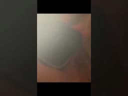 1 Minute Of Top ASMR Pimple Popping Video №93