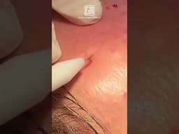 Kobayashi Acne Treatment ASMR 🔊