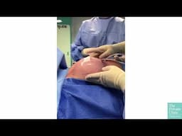 What happens during a Breast Augmentation?