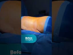 Live from Operating Room: 360 tummy tuck, waist liposuction, arm lift surgery