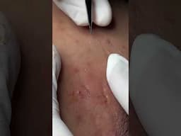 Linh My Dang Acne - 19/03/2025