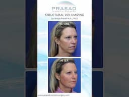 How Facial Filler is Placed Differently with Structural Volumizing #filler