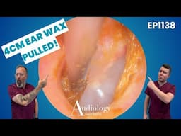 4cm Ear Wax Plug + Deep Skin Peel! Satisfying Extractions & Surgical History 👂🔥  EP1138