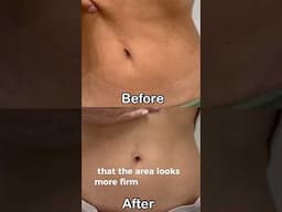 I tried Sculptra on my Abs- Sculptra before & After #sculptra #beforeandafter