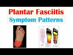 The Interesting Symptoms of Plantar Fasciitis