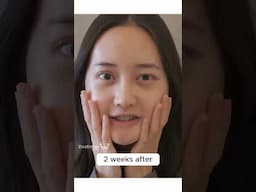 They say I don't need Plastic surgery but I did it in Korea anyway! #plasticsurgerykorea