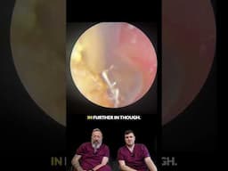Chock Block’ Ears & Balance Trouble? Watch This Ear Wax Removal 👂😳