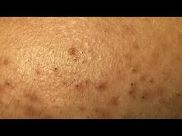 Acne Treatment Huong Da Nang#730  Remove Blackheads And Whiteheads