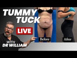 Secrets to the Best Tummy Tuck Results—Live Q&A with Dr. William