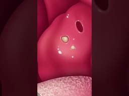 How Tonsil stones forms: What are Tonsil stones (3d Animation)