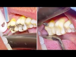 Metal Fillings Removed & Replaced with White Fillings. Amalgam vs. Resin Composite!