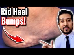 Mysterious Bumps on Heels | How to Get Rid of Piezogenic Papules