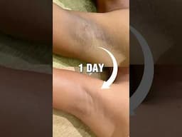 Dark Underarms Whitening in Just 1 Day #shorts #skincare