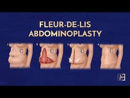 Fleur de Lis Abdominoplasty: Comprehensive Solution for Post-Weight Loss Skin Removal